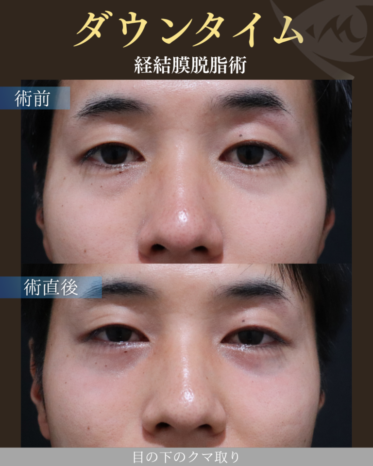 20代男性 経結膜脱脂術 ダウンタイム